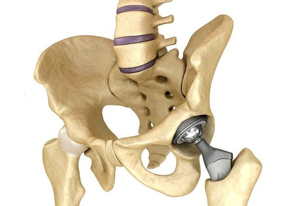 Opthéticos internos de la articulación de la cadera