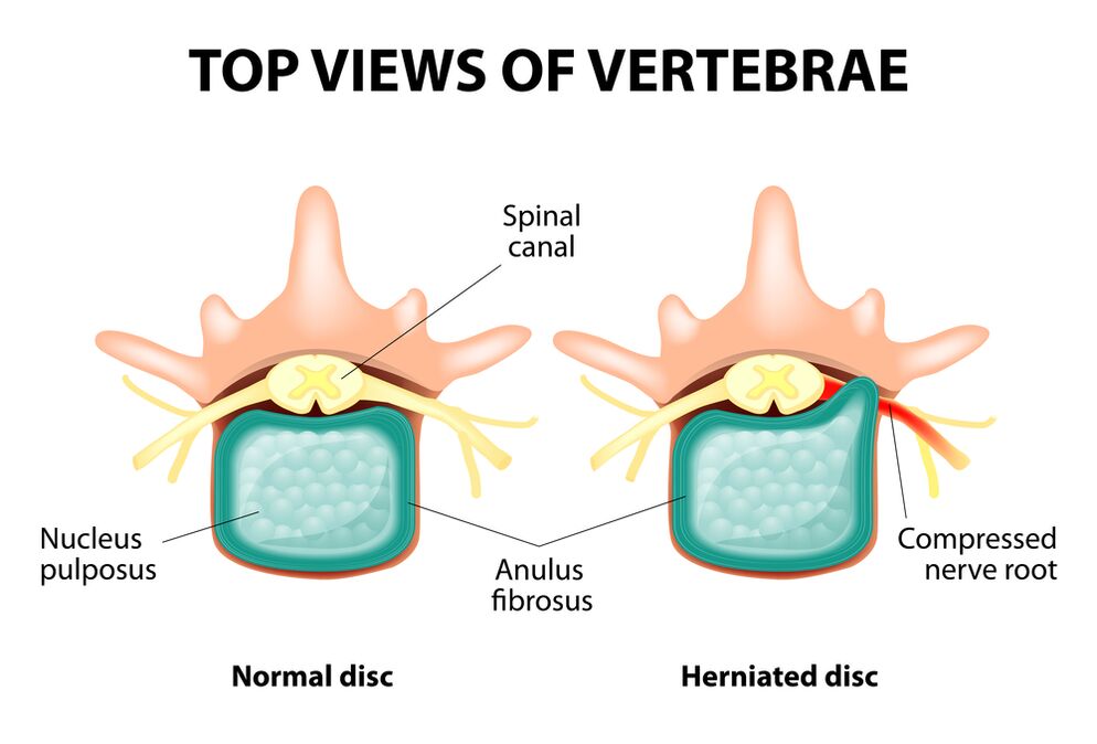 Discos saludables y hernia