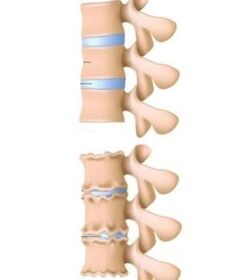 Causas de osteocondrosis
