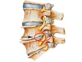 Signos y síntomas de la osteocondrosis