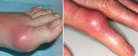 La aparición de articulaciones artríticas.