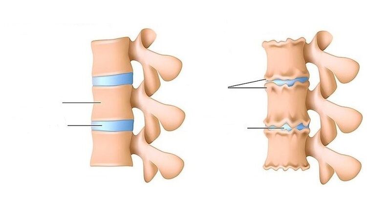 Columna vertebral sana y columna afectada por osteocondrosis