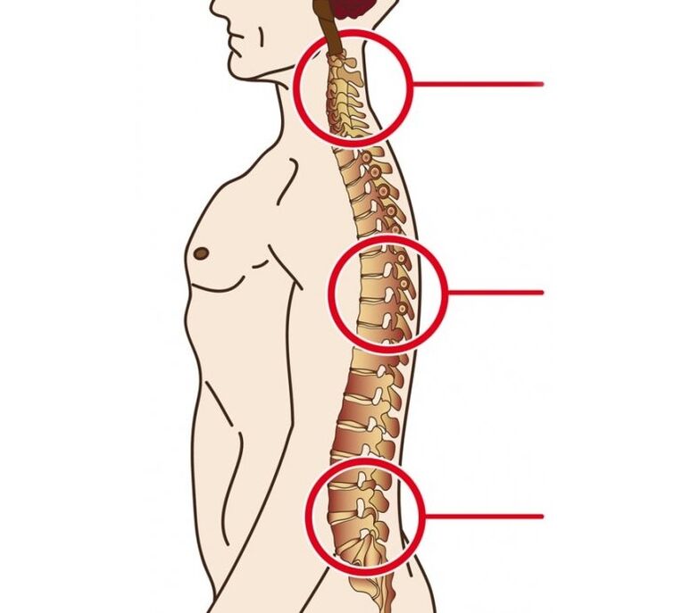 Localización de la osteocondrosis cervical, torácica y lumbar.