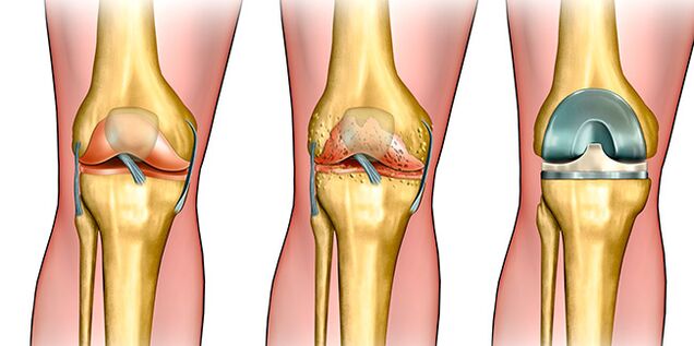 En la tercera etapa de la artrosis se requiere cirugía de reemplazo de rodilla.