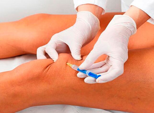 Inyección intraarticular de medicamentos para tratar la enfermedad de la articulación de la rodilla.
