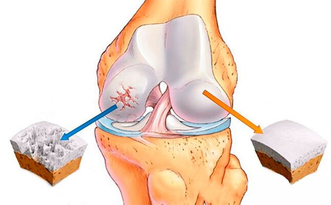 Rodilla normal (derecha) y rodilla afectada (izquierda)