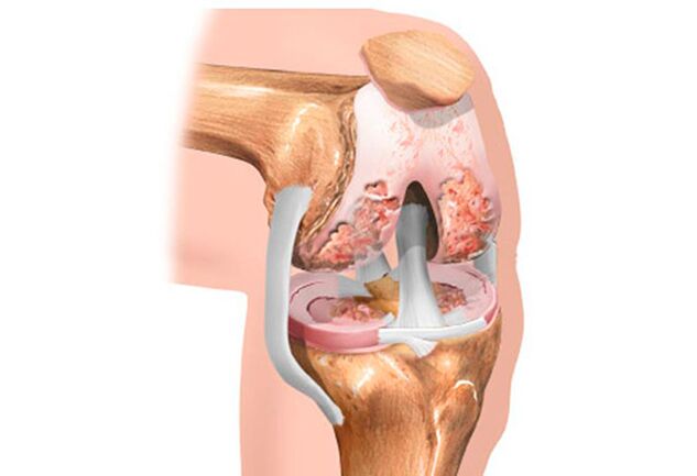 artritis de rodilla